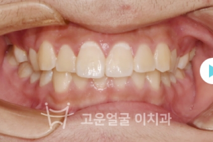 치료후기 이미지